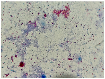Figure 2.- ZiehlNeelsen stain: numerous acid-fast bacilli.