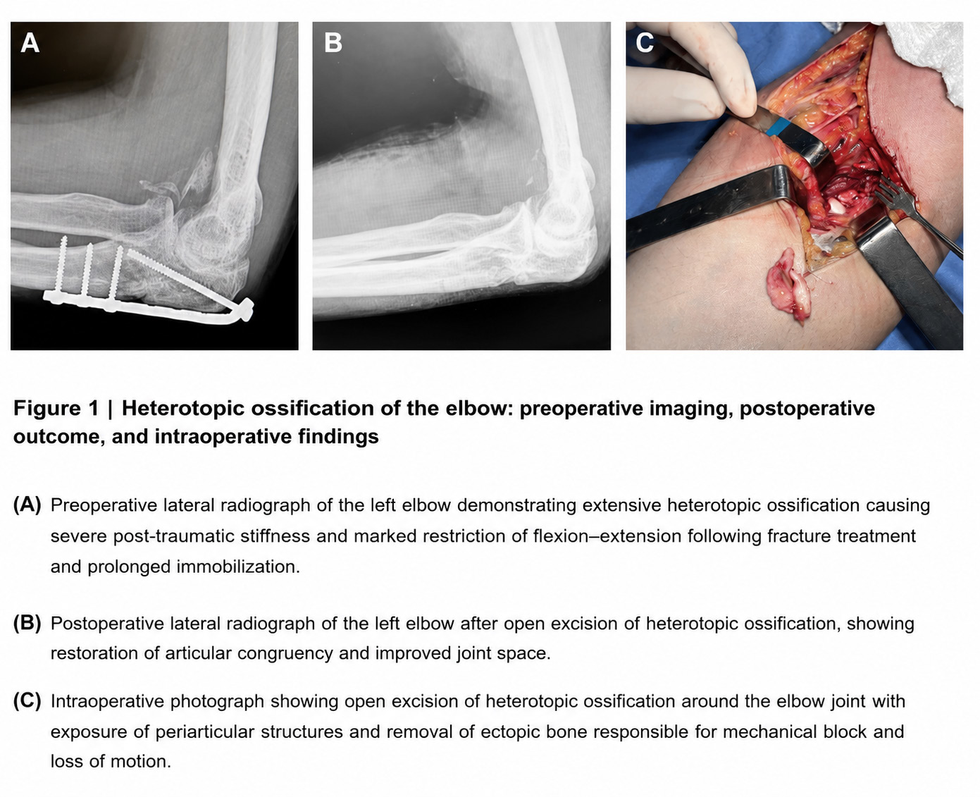 Figure 1 illustrates a representative case of post-traumatic HO o extensive ectopic bone formation associated with severe postoperative radiograph shows improved joint space and rest